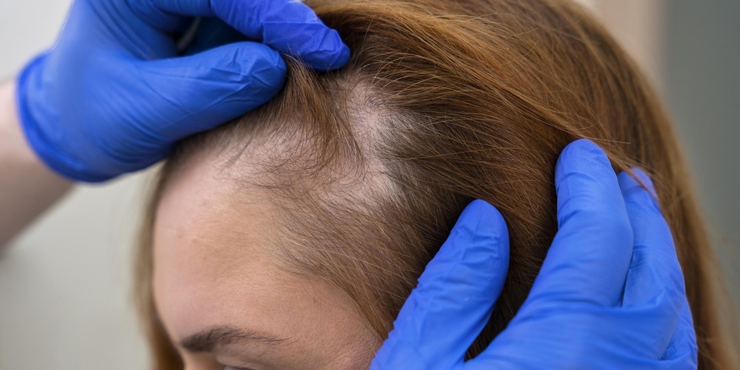 How to Regrow Hair on Bald Spot