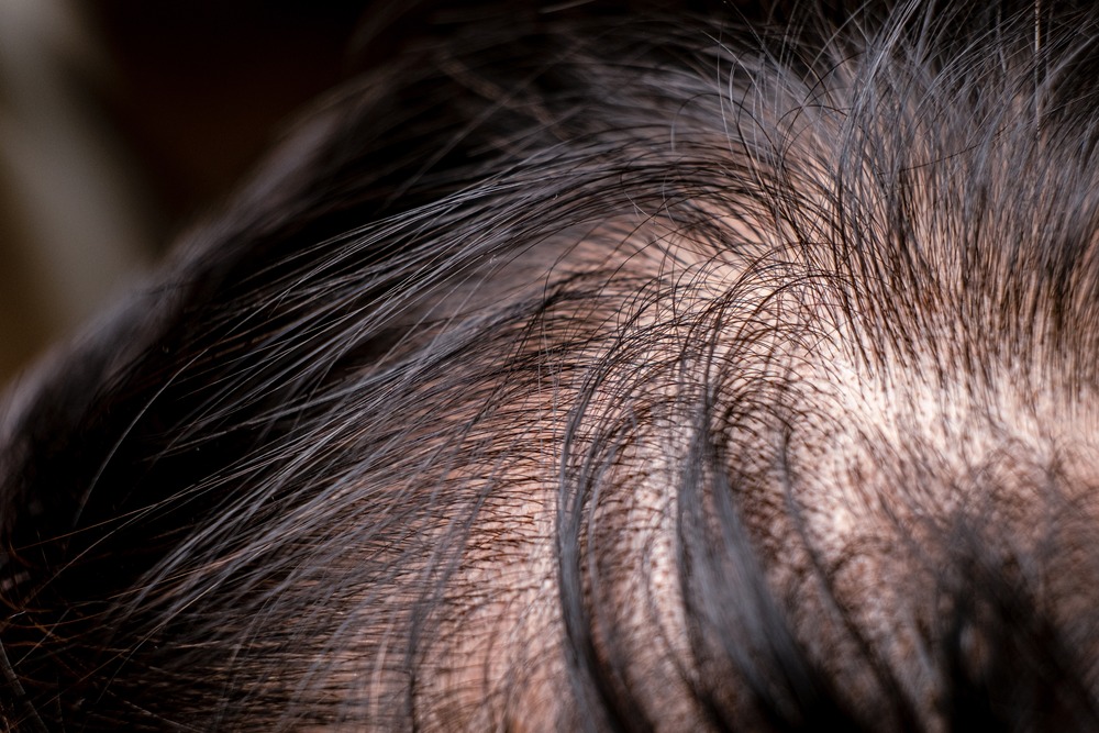COMMON ISSUES OF HAIR THINNING 