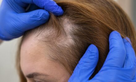 How to Regrow Hair on Bald Spot