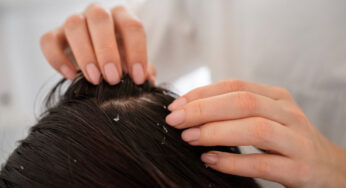 Why Dandruff Causes Hair Loss and How to Stop It